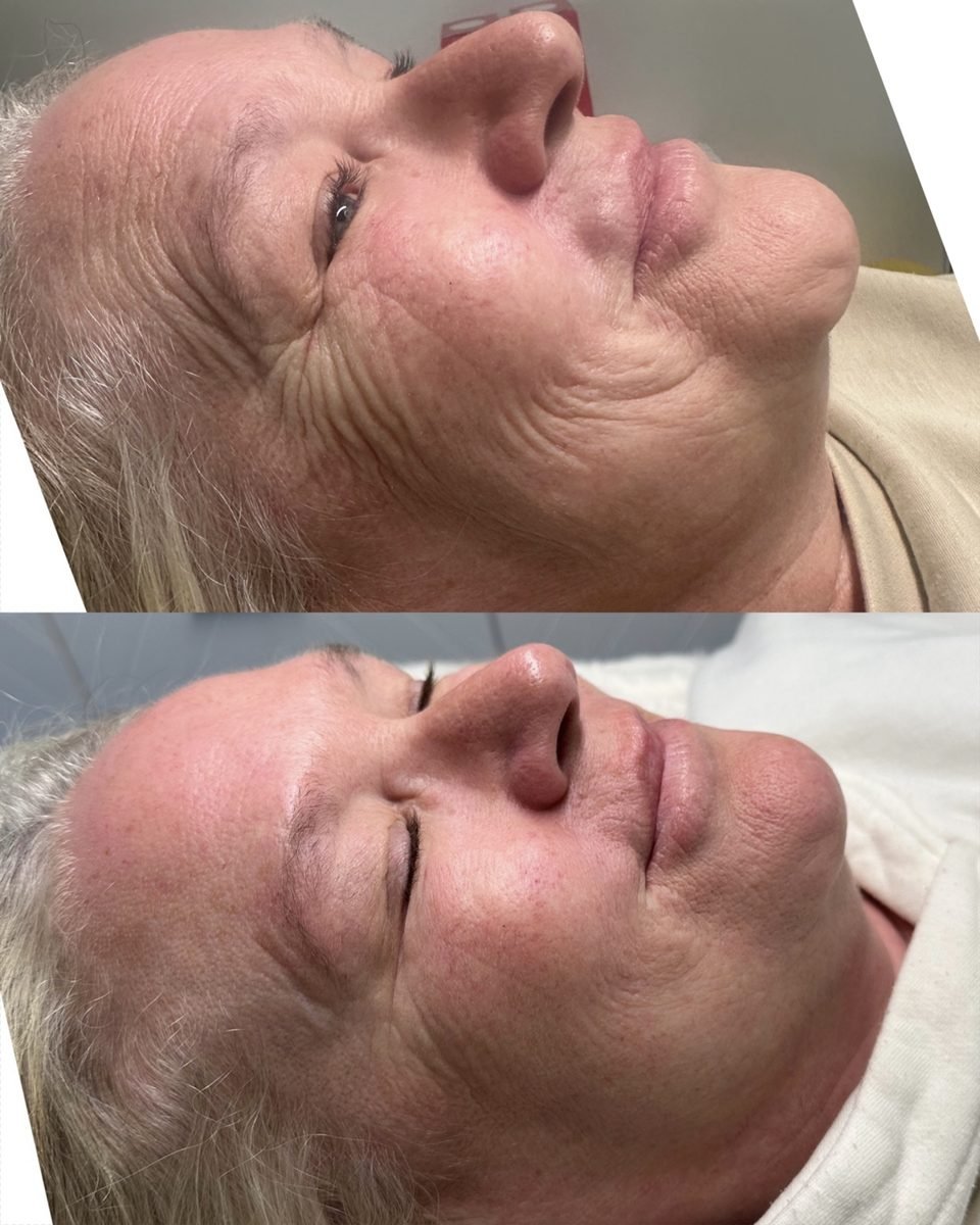 Anti-Wrinkle & Skin result at BKM Aesthetics, Nottingham