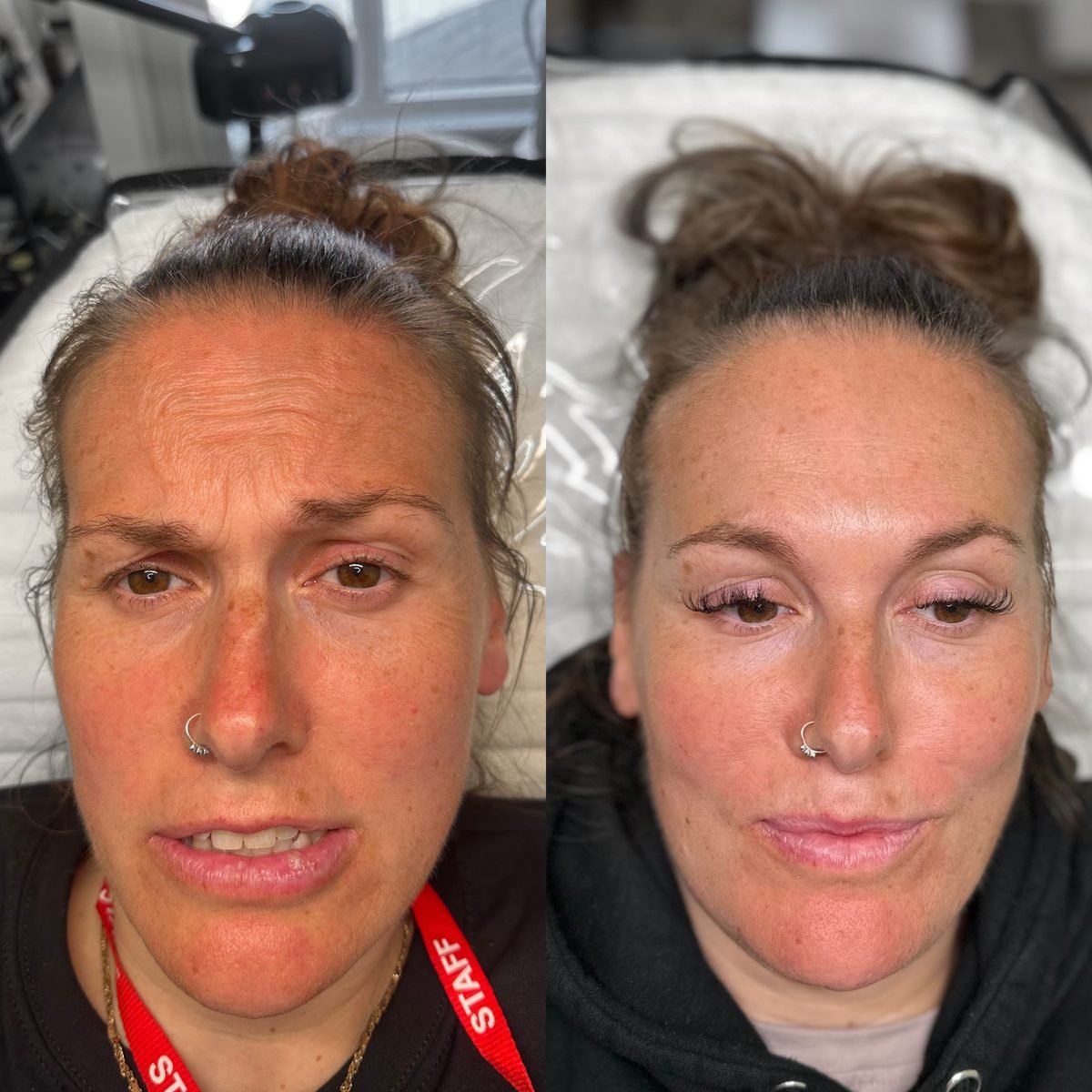 Anti-Wrinkle & Skin result at BKM Aesthetics