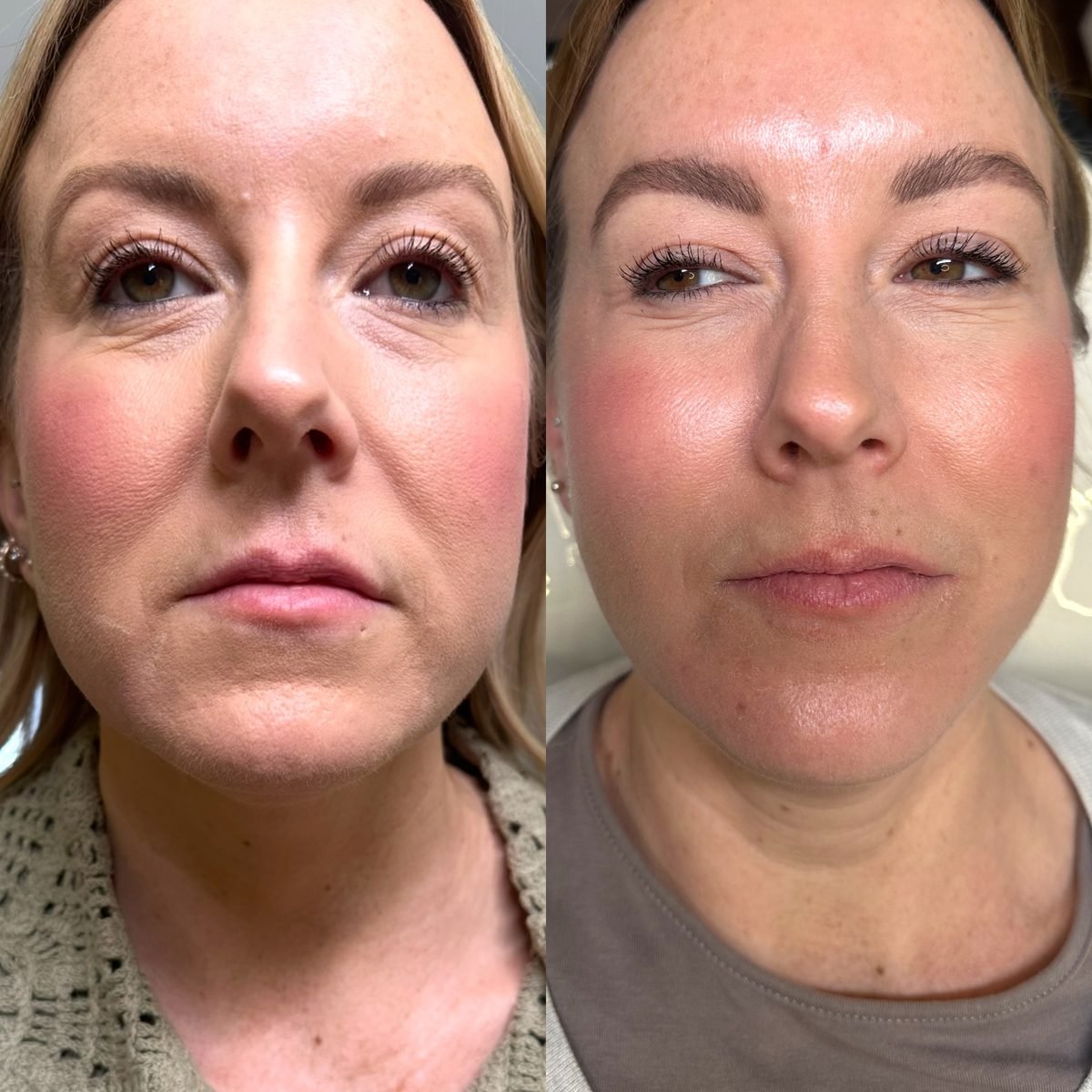 Anti-Wrinkle & Skin result at BKM Aesthetics, Nottingham
