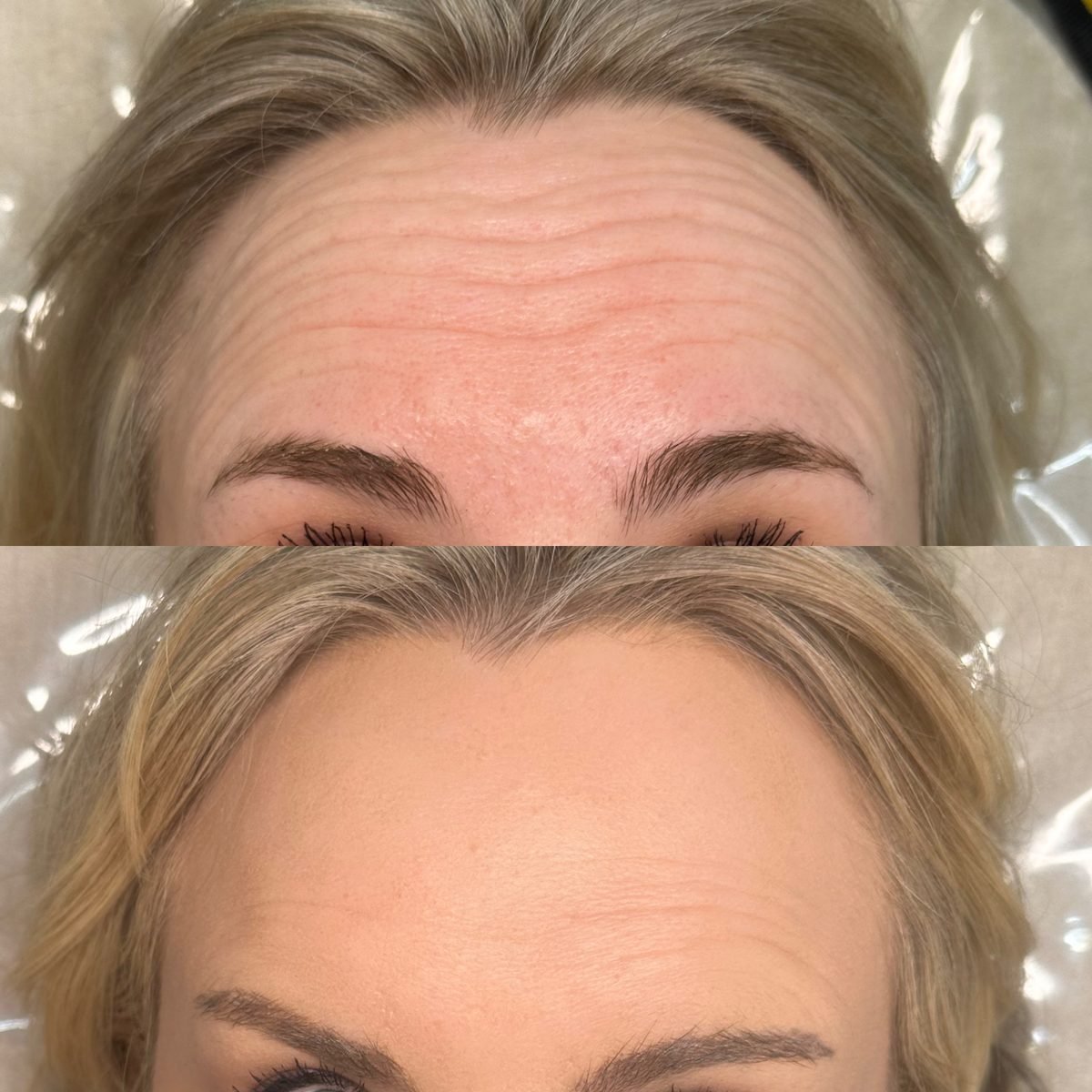 Anti-Wrinkle & Skin result at BKM Aesthetics, Nottingham