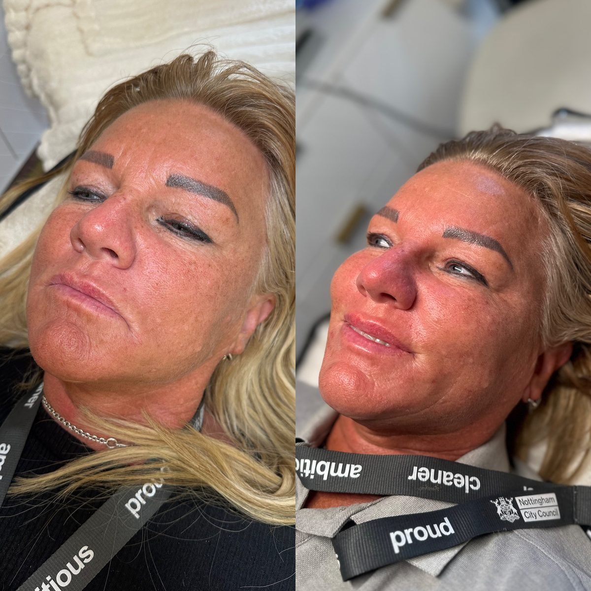 Anti-Wrinkle & Skin result at BKM Aesthetics, Nottingham