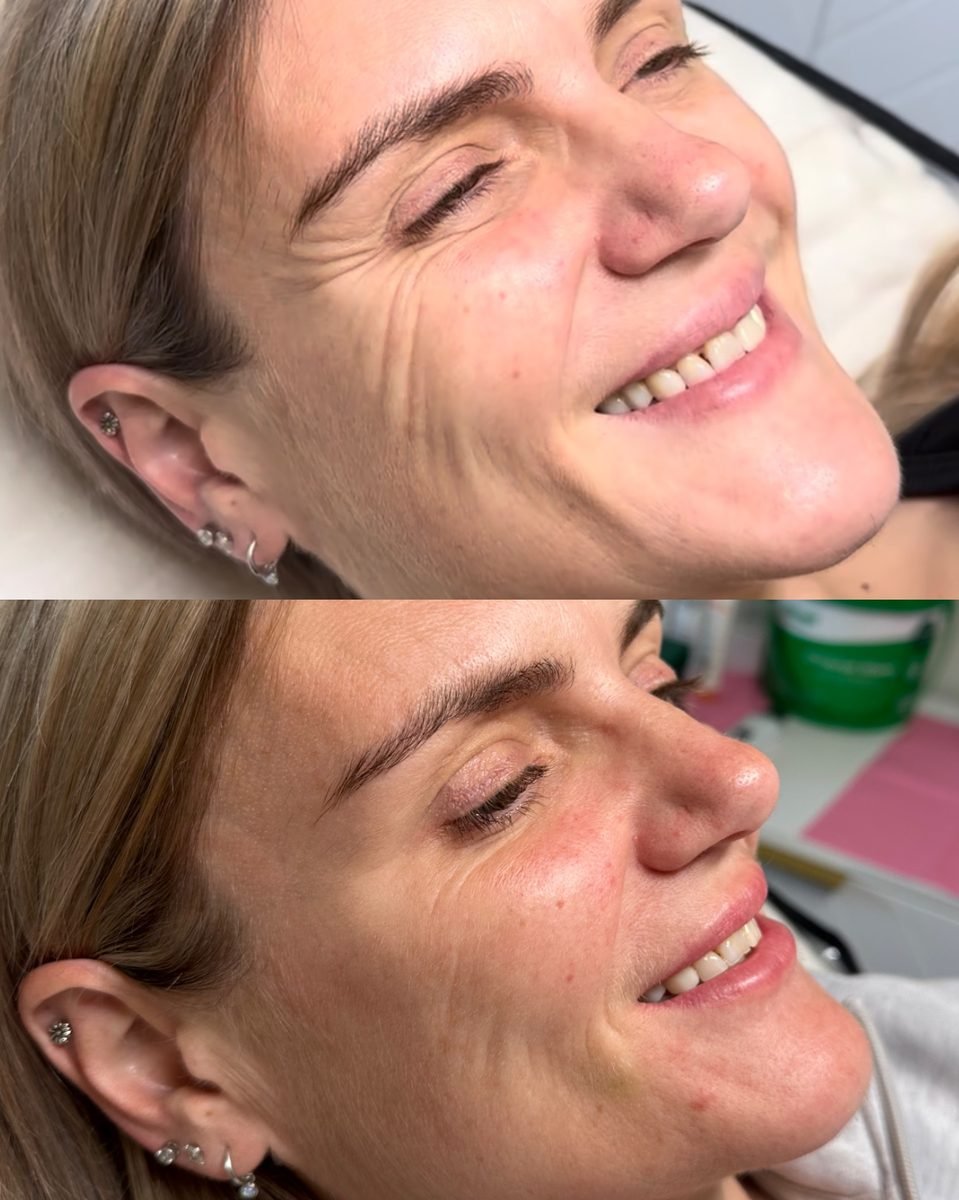 Anti-Wrinkle & Skin result at BKM Aesthetics, Nottingham