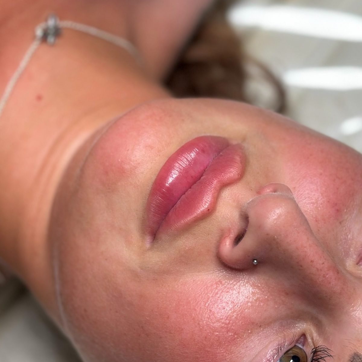 Lip Augmentation result at BKM Aesthetics
