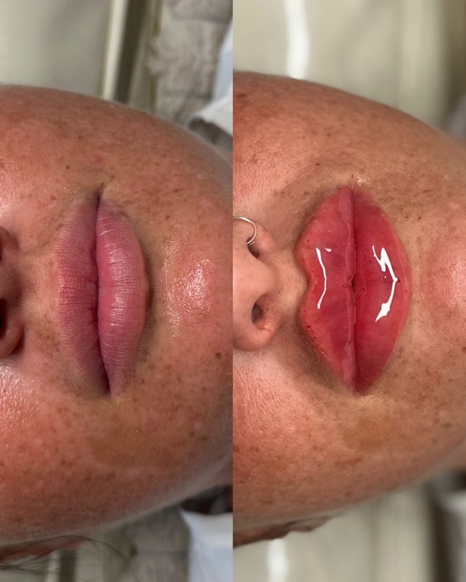 Lip Augmentation result at BKM Aesthetics, Nottingham