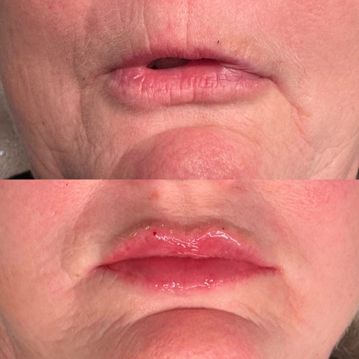 Lip Augmentation result at BKM Aesthetics, Nottingham