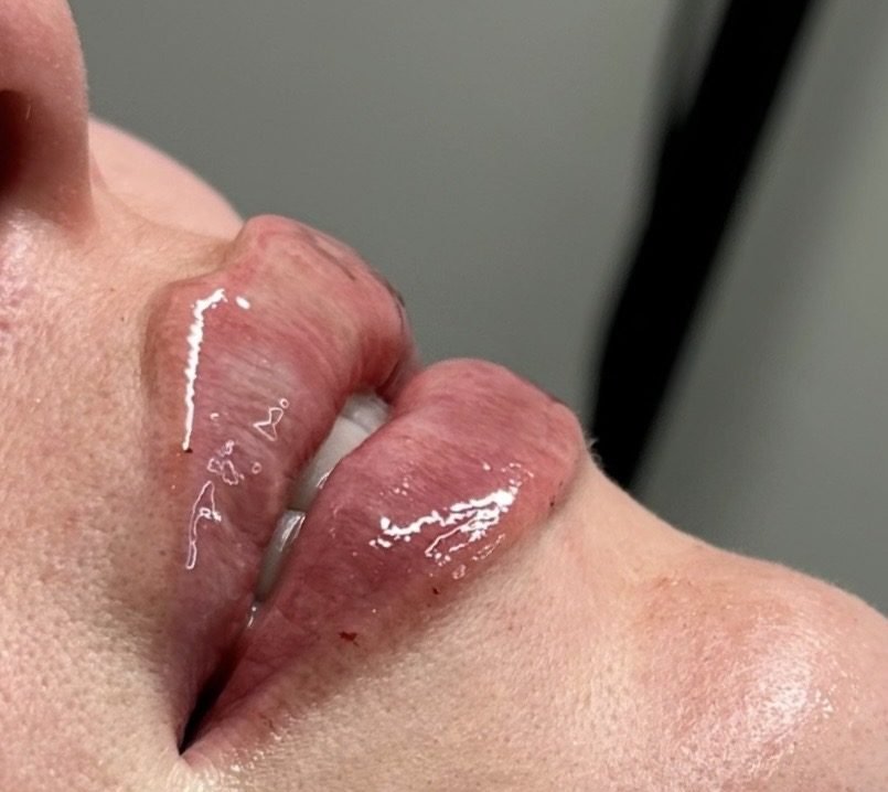 Lip Augmentation result at BKM Aesthetics