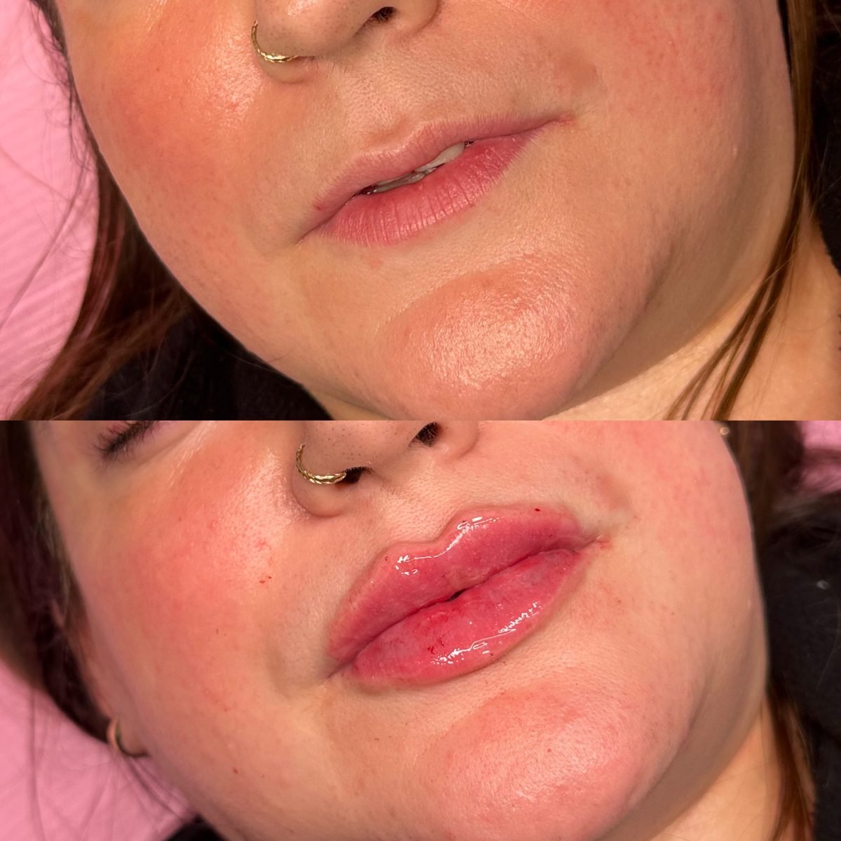 Lip Augmentation result at BKM Aesthetics, Nottingham