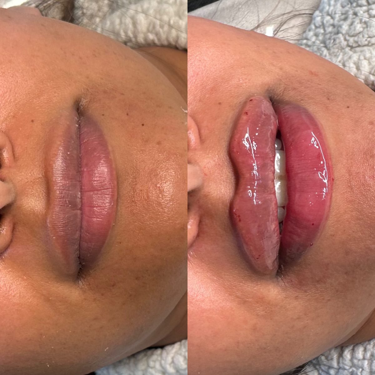 Lip Augmentation result at BKM Aesthetics, Nottingham