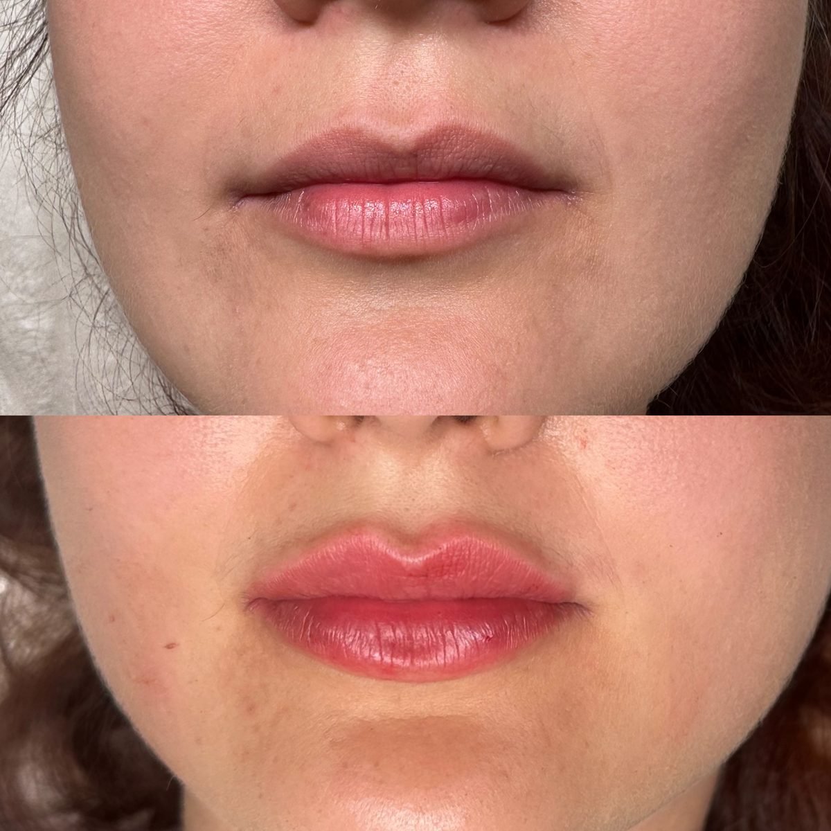 Lip Augmentation result at BKM Aesthetics, Nottingham