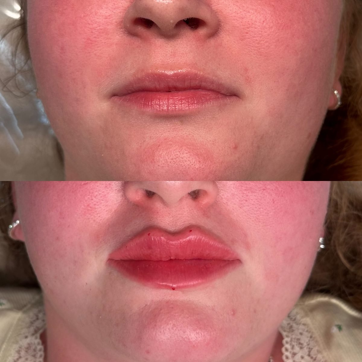 Lip Augmentation result at BKM Aesthetics, Nottingham