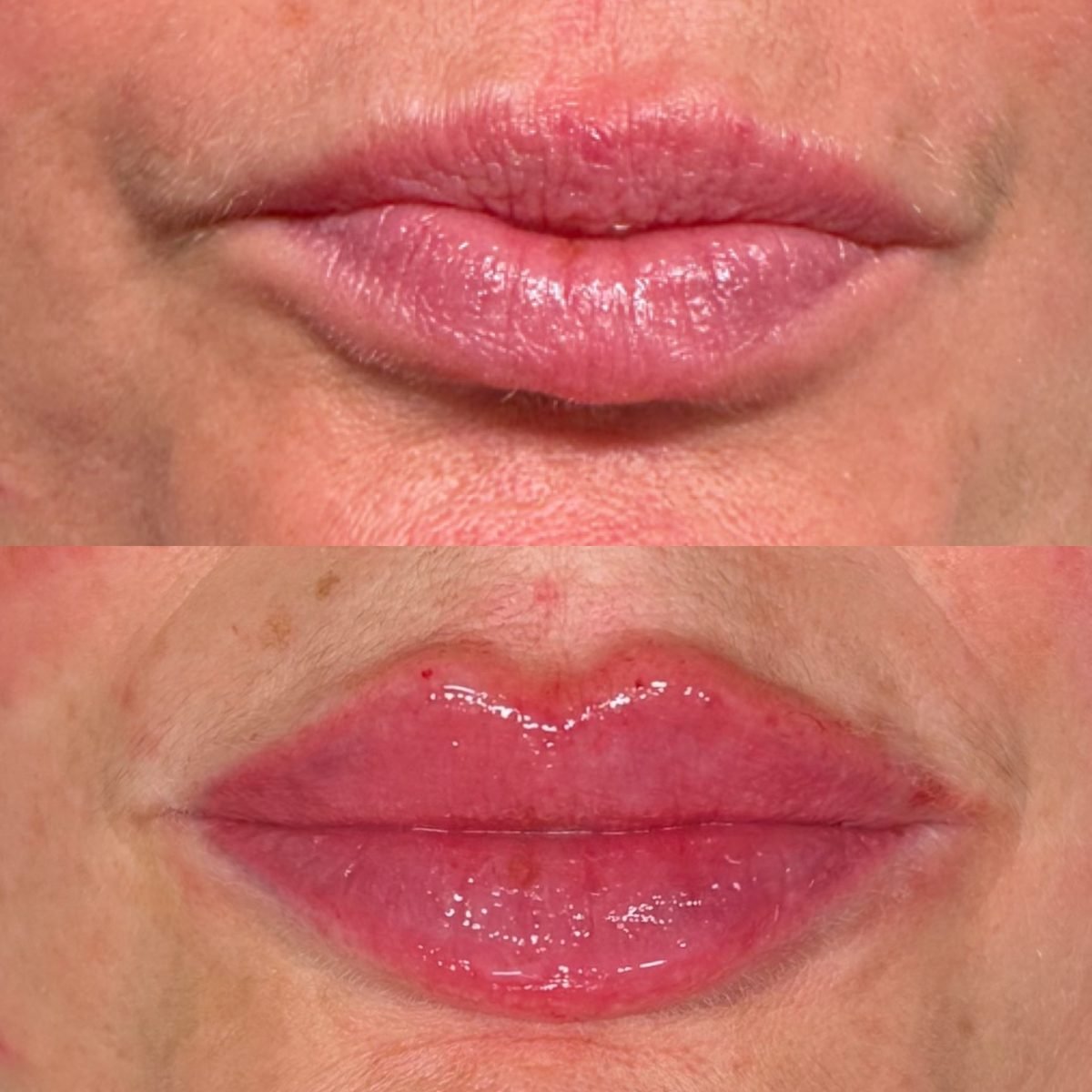Lip Augmentation result at BKM Aesthetics, Nottingham