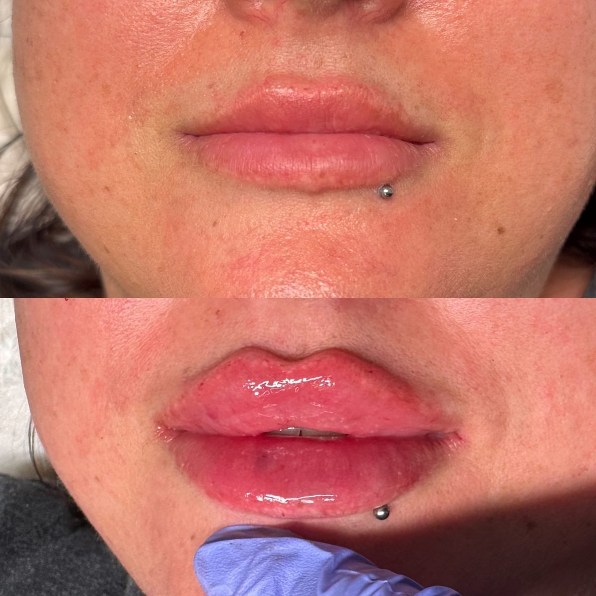 Lip Augmentation result at BKM Aesthetics, Nottingham