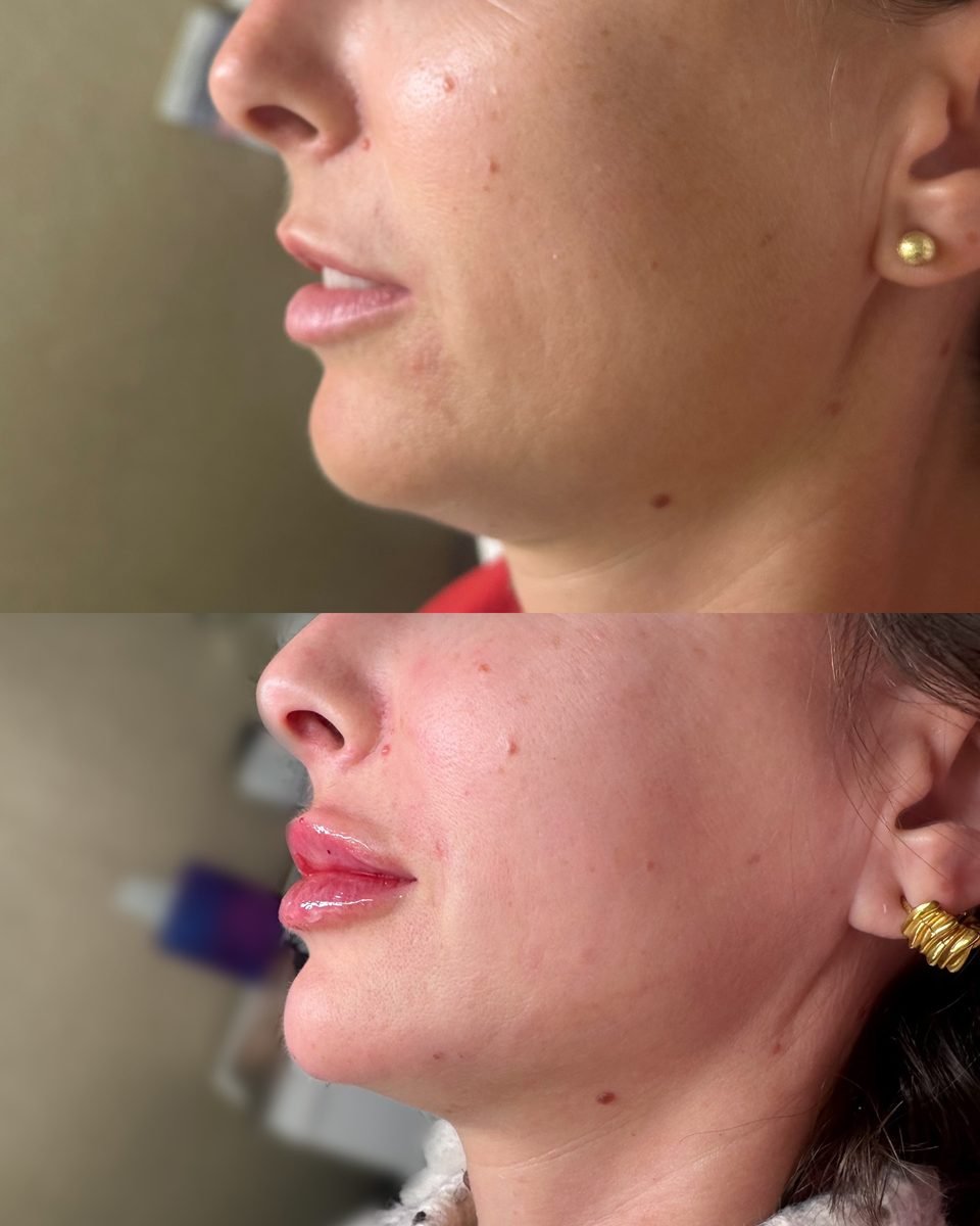 Profile Balancing result at BKM Aesthetics, Nottingham