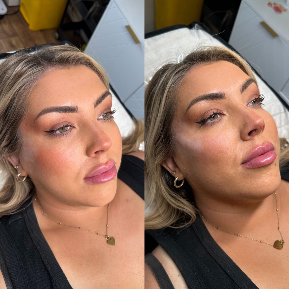 Profile Balancing result at BKM Aesthetics, Nottingham