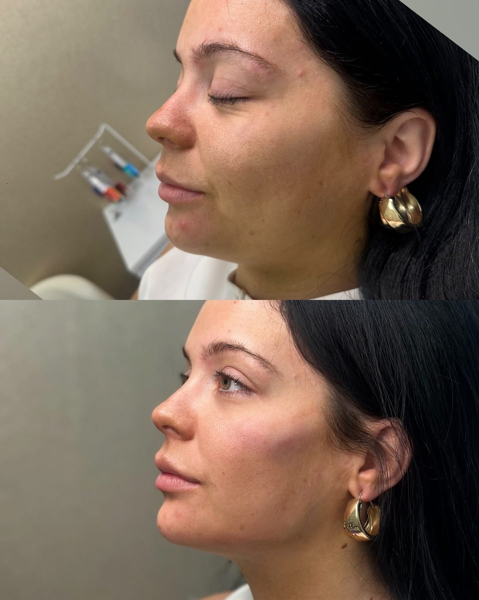 Profile Balancing result at BKM Aesthetics, Nottingham