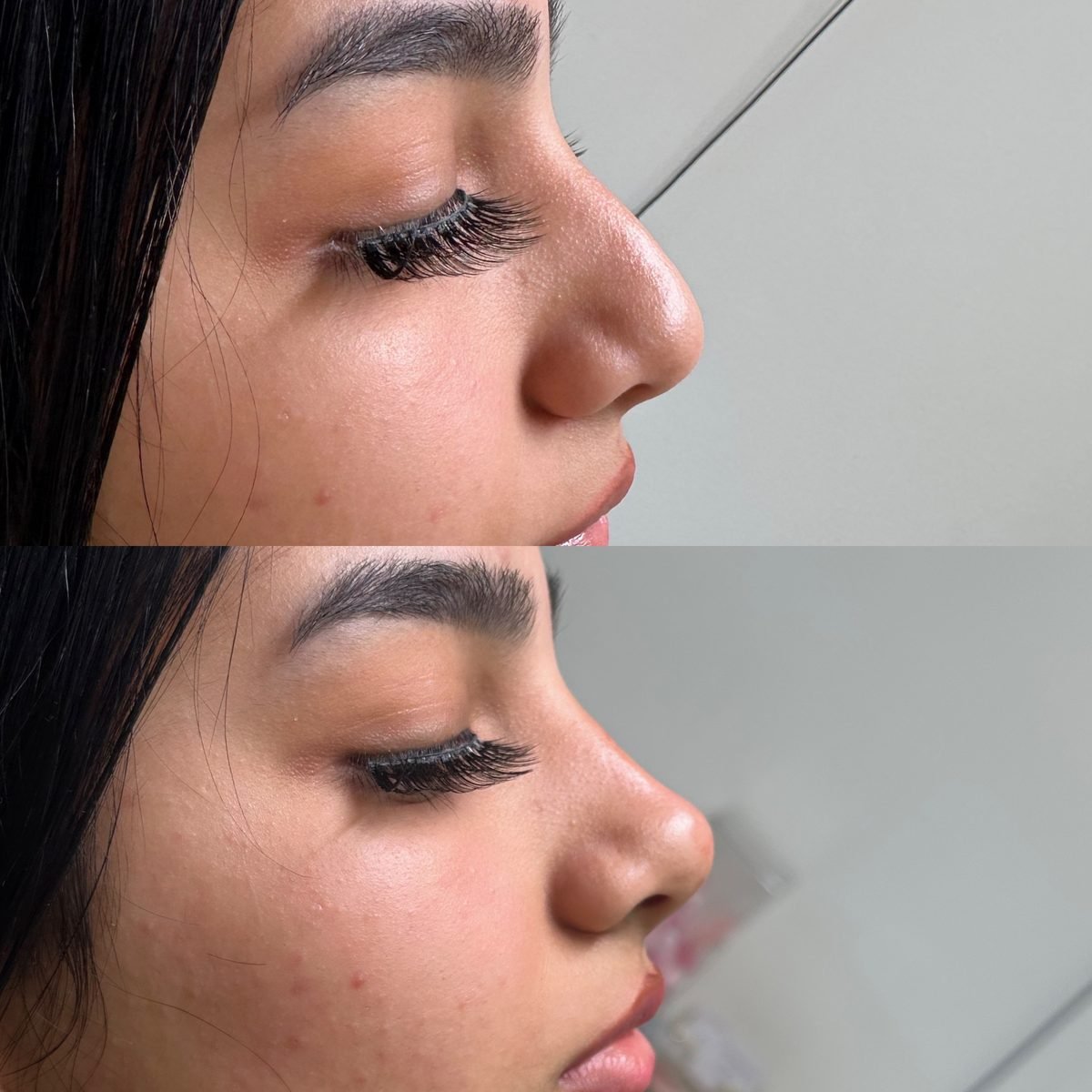 Non-Surgical Rhinoplasty result at BKM Aesthetics
