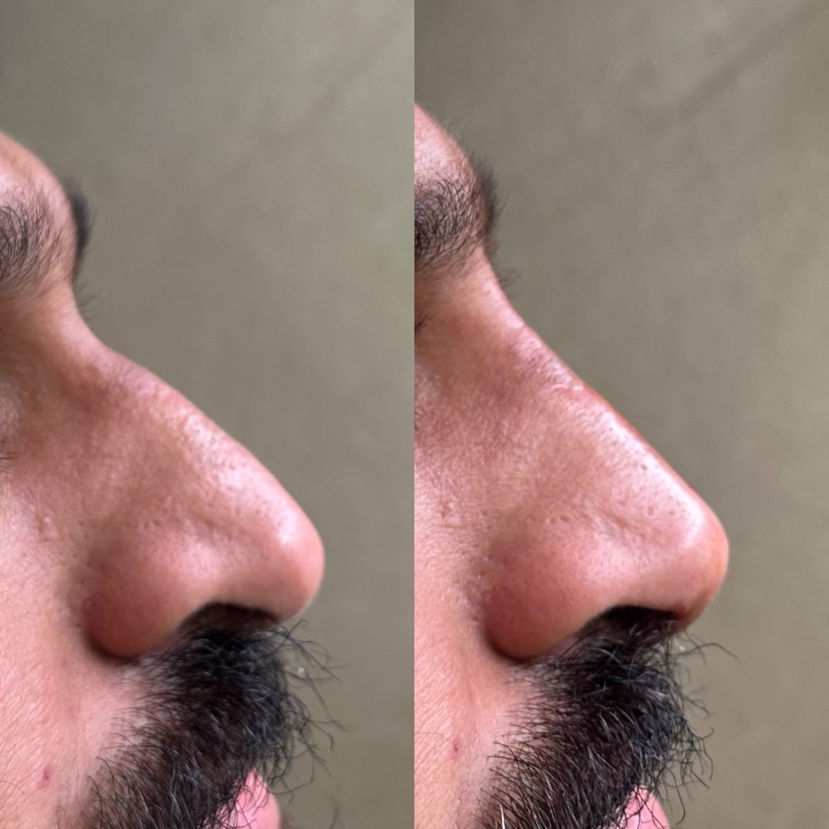 Non-Surgical Rhinoplasty result at BKM Aesthetics