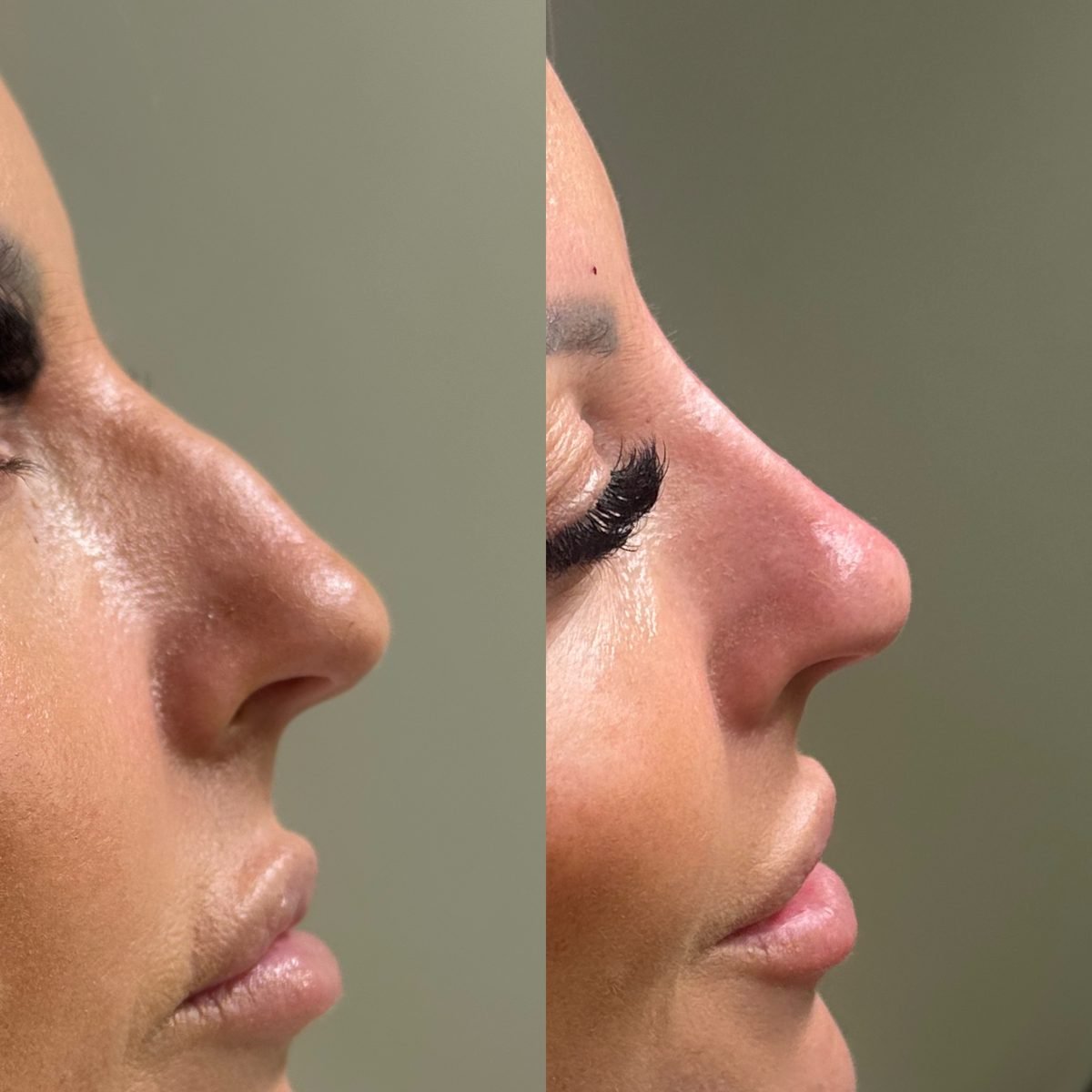 Non-Surgical Rhinoplasty result at BKM Aesthetics, Nottingham