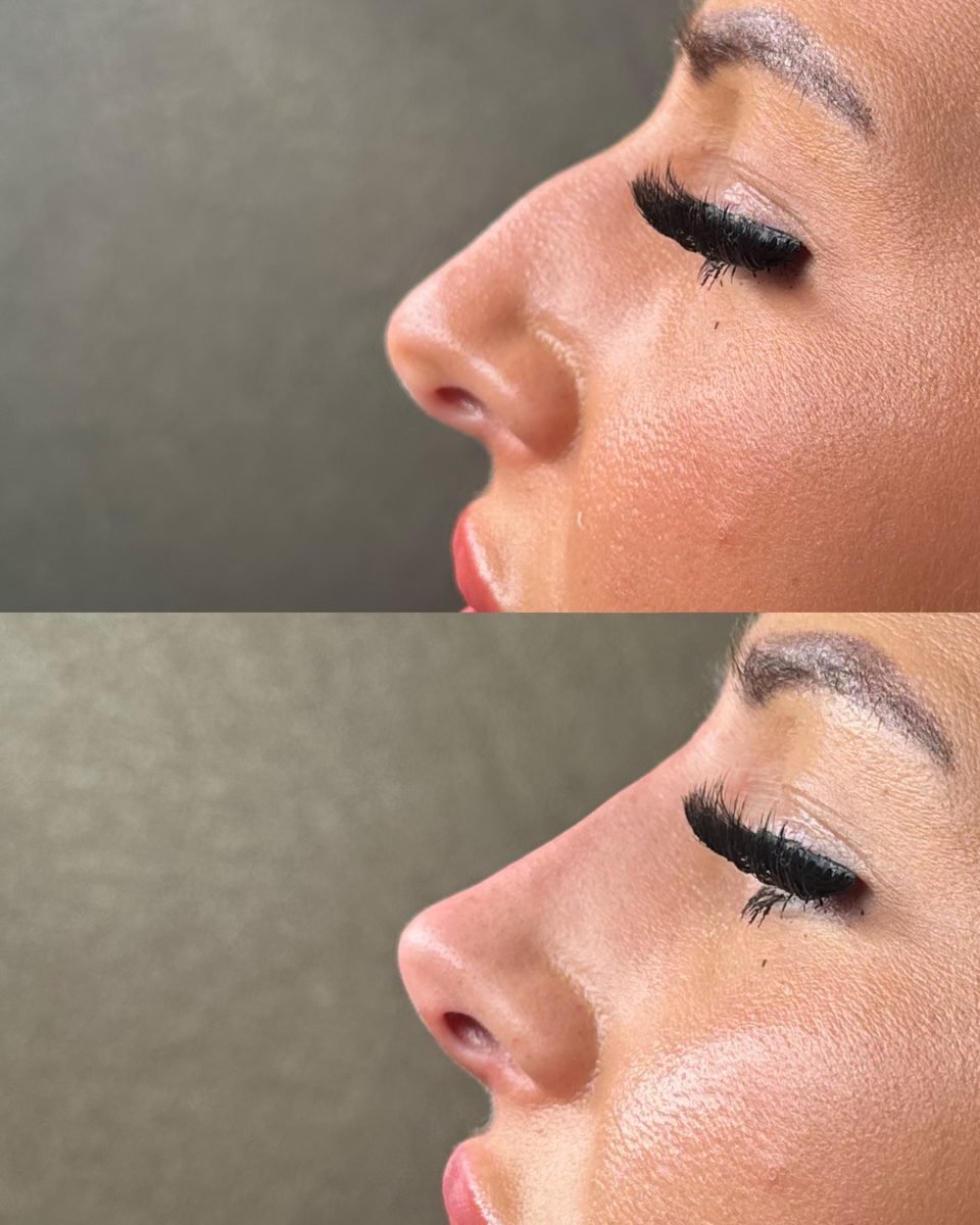 Non-Surgical Rhinoplasty result at BKM Aesthetics, Nottingham